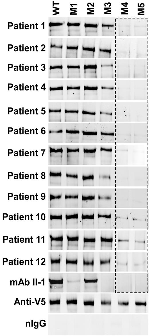 Figure 5. Binding of anti-ADAMTS13 IgGs from TTP patients to ADAMTS13 and variants. WT or variants M1 to M5 (50 ng) were incubated with mAb II-1 (35μM) or TTP patient plasmas (5-10 μL each, depending on plasma IgG concentrations). The immune complexes were pulled down with protein A-Sepharose 4B and detected by Western blotting with anti-V5. Anti-V5 IgG coupled Sepharose 4B beads were used for a positive control. Normal IgG from healthy persons (nIgG) was used for a negative control.