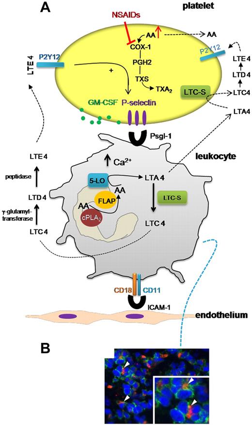 Inside platelet-leukocyte cross-talk in aspirin exacerbated respiratory disease. (A) In AERD, enhanced propensity of platelets to adhere to leukocytes translates into increased biosynthesis and release of LTC4 that is metabolized to LTE4 by the activity of enzymes present in plasma. LTE4 may interact with platelet P2Y12 receptor, thus inducing platelet P-selectin expression and facilitating the formation of platelet-leukocyte aggregates. Other platelet products, such as GM-CSF, can be released and may activate leukocyte 5-LO and induce a pro-adhesion phenotype and prolong the survival of eosinophils. As shown in panel B (from Figure 1 in the article by Laidlaw et al beginning on page 37901), nasal polyps from subjects with AERD contained many extravascular platelets that co-localized with leukocytes. In this scenario, NSAID treatment may increase the biosynthesis of cys-LTs. NSAIDs inhibit platelet COX-1 that can cause the accumulation and release of free AA that can be taken up by leukocytes thus inducing 5-LO translocation and enhancing cys-LT generation. PGH2 indicates prostaglandin-H2; and TXS, thromboxane synthase.