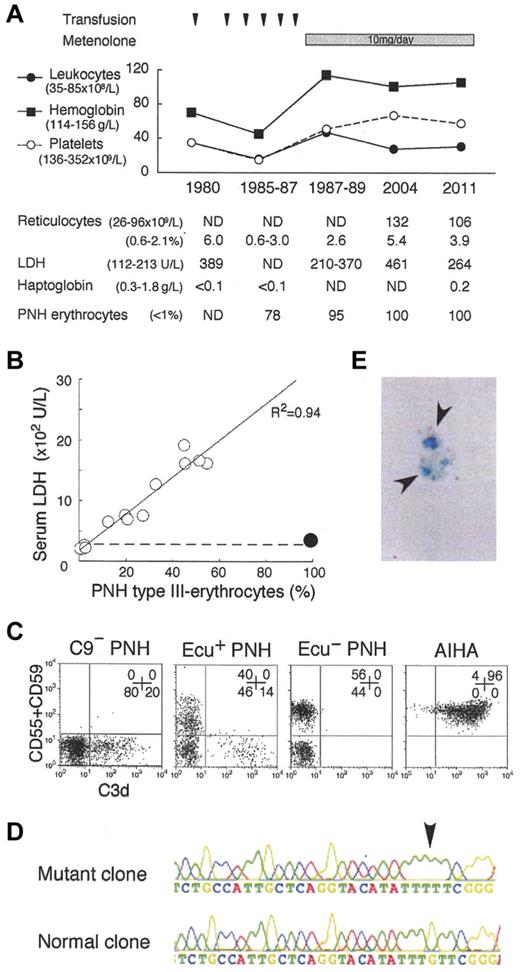Figure 1. Analysis of the C9-deficient patient with PNH. (A) Clinical profile of the C9-deficient patient with PNH. ND indicates not determined; and PNH erythrocytes, negative for both CD55 and CD59. (B) Correlation between LDH levels and PNH type III erythrocytes (%). ○, 14 patients with PNH; •, C9-deficient patient with PNH; dashed line, upper limit of normal LDH range. (C) C3d expression on erythrocytes of PNH patients with C9 deficiency (C9− PNH), with eculizumab (Ecu+ PNH), without eculizumab (Ecu− PNH), and of a patient with autoimmune hemolytic anemia (AIHA). Numbers indicate the population (%) of cells in each quadrant. (D) Arrow indicates a PIGA mutation, deletion of G (352), in the granulocyte genome exon 2 of C9− PNH. (E) Arrows indicate urine hemosiderin stained with Prussian blue of C9− PNH.