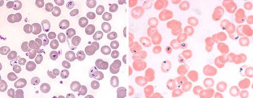 A 65-year-old woman with long-term alcohol abuse was admitted with fatigue, loss of appetite, and weight loss. Her past history included gastric surgery complicated by spleen rupture and subsequent splenectomy. Her physical examination was normal except for cachexia. She had a normocytic anemia (7.4 g/dL) with normal leukocyte and platelet counts, electrolyte abnormalities, and deficiencies of vitamins B1 and D. A blood smear showed red cell inclusions (left panel of figure) in approximately 20% of the erythrocytes. A Perls stain (right panel of figure) affirmed that the inclusions were iron positive (Pappenheimer bodies). While hospitalized, she was treated with optimal nutrition and vitamin B supplementation and was kept free of alcohol. One week later the fraction of erythrocytes with Pappenheimer bodies had decreased to 10%, and the patient was discharged soon after. / Dr A. M. Pappenheimer described the appearance of iron inclusions on the Wright stain. These iron inclusions had been previously noted on Prussian blue stains. Pappenheimer bodies are more evident in asplenic individuals; however, they may also be found in patients with alcohol excess, sideroblastic anemia, and lead poisoning. Other red cell inclusions, such as Howell Jolly bodies and Heinz bodies, which are also seen more frequently in asplenic individuals, are negative with iron stains.