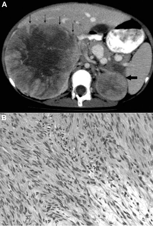 Figure 1. Radiologic and histologic findings. (A) Axial CT view of the upper abdomen after intravenous contrast injection and oral contrast administration: Large solid mass in the right suprarenal region with faint central calcification and central stellar hypodensity. Small arrows indicate the anterior border of this mass. The smaller more homogeneous solid lesion in the left suprarenal region is indicated by one large arrow. The right-sided lesion displaces the inferior vena cava anteriorly and medially, and there is visibility of an intracaval defect corresponding to a clot. (B) H&E stain showing elongated spindle cells arranged in a storiform pattern admixed with scattered chronic inflammatory cells (original magnification ×400). The images were captured digitally through a Nikion Eclipse i80 microscope (Nikon) with a 40×/0.75 objective at room temperature without flourochromes. The camera was a Pixelink PL-SW Microscopy (Canimpex Enterprise Ltd) with acquisition software of Pixelink Capture SE Version 4 software for Windows XP (Canimpex Enterprise Ltd). No subsequent image reprocessing occurred.