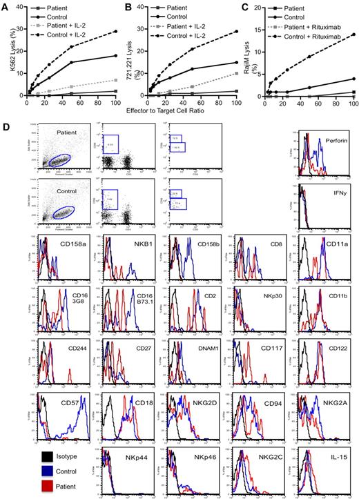 Figure 2. Deficient patient NK cell numbers and cytolytic functions. Evaluation of the NK cell cytotoxicity by 4-hour 51Cr-release assay against (A) K562, (B) 721.221, or (C) Raji target cells using PBMCs. For the Raji cells, lysis was evaluated with or without the addition of rituximab to opsonize the cells as indicated in the legend. For K562 and 721.221 target cells, 1000 U/mL IL-2 was added to the assay for its duration as indicated in the legends. Statistical significance was calculated using the Mann-Whitney U test. (D) Phenotypic evaluation of NK cells demonstrating forward versus side scatter gating strategy (left), CD56 versus CD3 with the square gate denoting classic NK cells (middle-left), the presence of CD16 on the gated CD56+/CD3− NK cells using 2 different clones of anti-CD16, B73.1, and 3G8 (middle right), and the expression of CD56 as a percentage of maximal expression on the gated NK cells (right). Results for the patient (top) and a control (bottom) are shown. Evaluation of NK cell subsets and functional markers are for gated CD56+/CD3− classic NK cells only. Fluorescence intensity for an IgG isotype control (black) is shown compared with that for the antigen-specific antibody for a control (blue) and the patient (red). The control IgG for the patient is shown but was similar to that for the control donor. All results are representative of at least 3 independent repeats. NKp44, NKG2C, and IL-15RB were performed on a sample separate from the others.