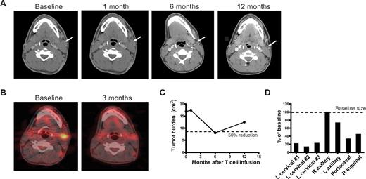 Figure 4. Clinical response to T-cell infusions. Patient UPN-04 was treated with CY 1 g/m2 2 days before the first of 3 infusions of αCD20-28-BB-ζ CAR+ T cells, which were given 2 to 5 days apart and followed by 14 days of subcutaneous IL-2 injections. (A) Response in a cervical lymph node as imaged by CT scan of the neck at baseline and 1, 6, and 12 months after T-cell infusions. (B) PET-CT scan of the cervical lymph node at baseline and 3 months after T-cell infusions. (C) Change in tumor volume over time. The sum of the products of the diameters of the 7 largest lymph nodes seen on the baseline and 1-, 6-, and 12-month CT scans. (D) Heterogeneity of response in individual lymph nodes. The products of the diameters of the 7 largest lymph nodes from the 6-month CT scan are shown as a percentage of their baseline size. L indicates left; and R, right.