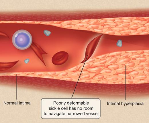The lumen of cerebral vessels in SCA patients having had a stroke is progressively filled with proliferated intima. Circulating in the narrowed vessels is a challenge for red cells whose deformability is reduced by the sickling. Professional illustration by Debra T. Dartez.