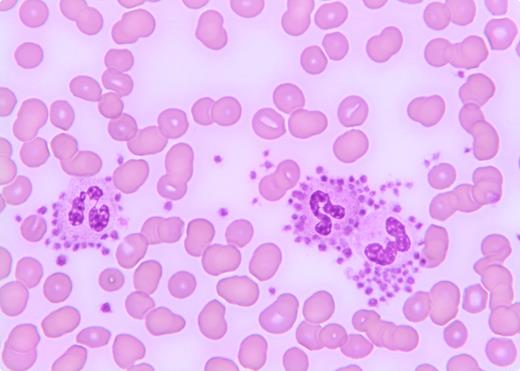 A 72-year-old male with a history of increasing dyspnea and weight loss underwent a chest X-ray that revealed a pulmonary mass and thus he was seen by pulmonary service for bronchoscopy. However, routine blood count showed a platelet count of 35 × 109/L with a normal hemoglobin and white blood cell count. He was referred to hematology for evaluation of thrombocytopenia. Physical examination was unremarkable. A repeat platelet count was 32 × 109/L. Review of the peripheral smear disclosed numerous platelets surrounding the granulocytes consistent with platelet satellitism (see figure) causing pseudothrombocytopenia. He underwent bronchoscopy without complications. / Spurious thrombocytopenia is a problem in clinical practice that may sometimes lead to unnecessary evaluations and treatment. Platelet satellitism, which is an in vitro phenomenon, is associated with EDTA-treated blood at room temperature. It is seen in patients with vasculitis, lupus, mantle cell lymphoma, and marginal zone B-cell lymphoma, and most commonly in healthy individuals. One of the proposed mechanisms is IgG autoantibodies directed against platelet glycoprotein IIb/IIIA complex and the neutrophil Fc γ receptor III. Astute clinicians should be familiar with this spurious cause of thrombocytopenia and should review the peripheral blood smear in all patients with thrombocytopenia.