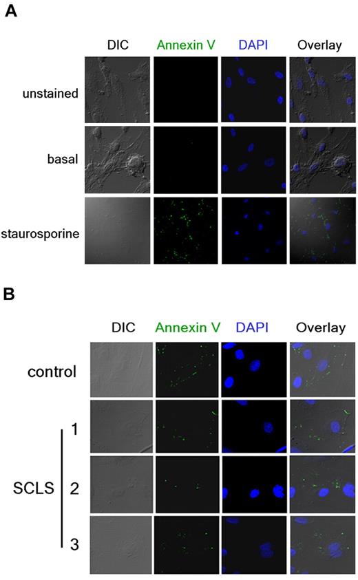 Figure 3. Detection of endothelial apoptosis by annexin V staining. (A) HMVECs were incubated overnight in the presence (bottom) or absence (top and middle) of staurosporine. Cells were left untreated (top) or stained with FITC-labeled annexin V Ab (green) followed by fixation and visualization by confocal microscopy. DAPI (blue) was used to identify nuclei. (B) Annexin V staining in growth factor–deprived HMVECs incubated overnight with sera pooled from healthy donors (“control”) or obtained from individual patients with SCLS during acute episodes (10% vol/vol concentrations). Images in panel A were taken at 40× and enlarged and or at 160× in panel B.