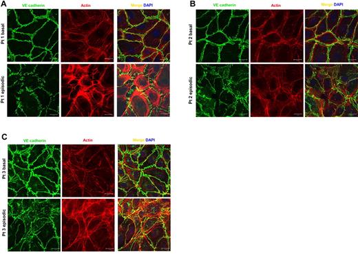 Figure 4. SCLS sera disrupt endothelial adhesive junctions and elicit retraction. (A-C) Matched basal or episodic serum from 3 patients with SCLS was applied to HMVEC monolayers followed by immunostaining with VE-cadherin Ab (green) and phalloidin (red) to identify F-actin. Bar scale = 20 μm.