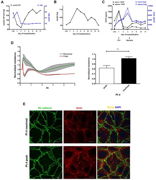 Figure 7. Elevations in circulating VEGF and Ang2 correlate with progression of an acute SCLS episode and induction of endothelial permeability. (A-B) Clinical course of a patient with a severe SCLS crisis characterized by hypotension, hemoconcentration (elevated Hgb; A) and a 20-kg weight gain in 3 days (B). (C) Serum and plasma VEGF and Ang2 in serial samples taken during the course of the illness were measured by ELISA. Baseline values were obtained 130 days before the episode during an asymptomatic period and at the beginning of the leak (admission to intensive care) and postleak (diuresis) phases as indicated by arrows. (D-E) Serum obtained at the peak of symptoms (“peak”) but not serum from the postleak resolution phase (“resolved”) induces endothelial permeability as assessed by decreased TEER (D) and reorganization of adhesive junctions and cell retraction (E); **P = .003, paired t test.