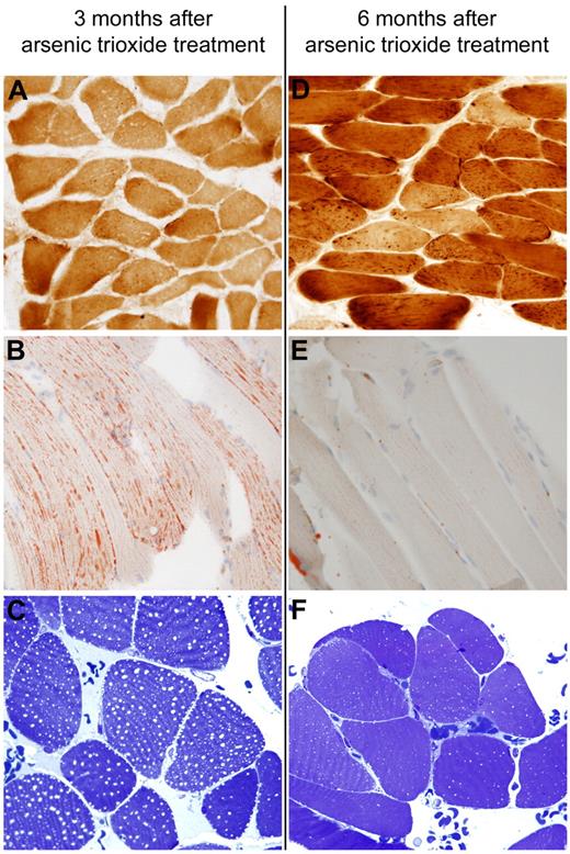 Figure 1. Muscle pathology. The first biopsy was performed 3 months after ATO treatment withdrawal and demonstrated decreased COX levels (A) and numerous lipid droplets in muscle fibers (B-C). The second biopsy was performed 6 months after ATO treatment was interrupted and demonstrated a dramatic improvement in COX levels (D) and a marked decrease in size and number of lipid droplets in muscle fibers (E-F). Frozen sections stained with COX (panels A,D, original magnification ×40); oil red O (panels B,E, original magnification ×40); and semithin sections stained with toluidine blue (panels C,F, original magnification ×100). For image acquisition information please see supplemental Methods.