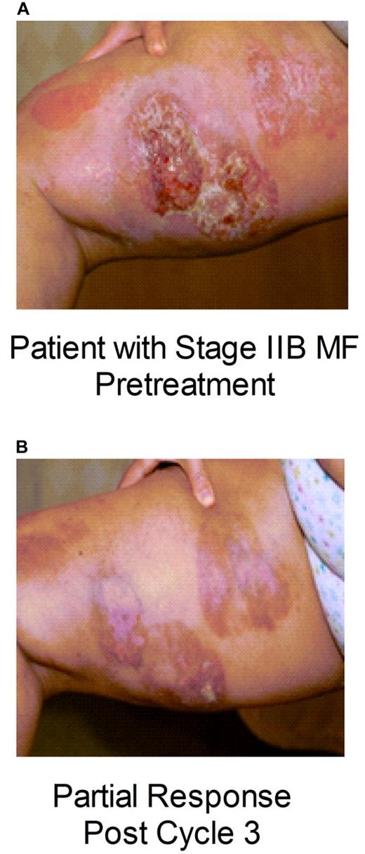 Figure 2. Response to pralatrexate in patients with cutaneous T-cell lymphoma. Skin photographs documenting disease in a patient with mycocis fungoides (MF) stage IIB (A) before the start of treatment with pralatrexate and (B) after 4 cycles of treatment with pralatrexate.