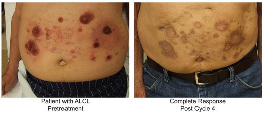 Figure 3. Response to pralatrexate in patients with cutaneous T-cell lymphoma. Skin photographs documenting disease in a patient with anaplastic large cell lymphoma before the start of treatment with pralatrexate and after 4 cycles of treatment.