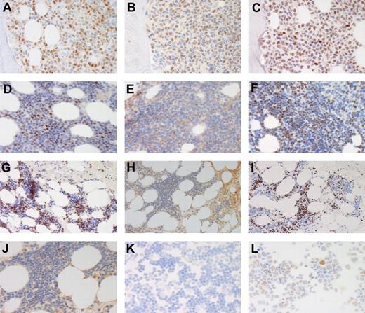 Figure 2. Immunostainings for cyclin D1, SOX11, and p53. Stainings for cyclin D1 (A,D,G), SOX11 (B,E,H,J-L), and p53 (C,F,I). BM of a case (case 80) of SOX11+, p53+ MCL (A-C). BM of SOX11−, p53+ MCL cases 125 (D-F) and 139 (G-I, higher magnification of SOX11 staining in panel J). For case 139 SOX11 was also negative in cells prepared from leukemic cells in peripheral blood (K) compared with the MCL cell line Rec1 (L). Original magnification, ×40 (A-F,J,K-L) and ×20 (G-I). Olympus BX45 microscope, (Olympus), DXC-S500 camera, (Sony), Picsara software (Euromed Network).