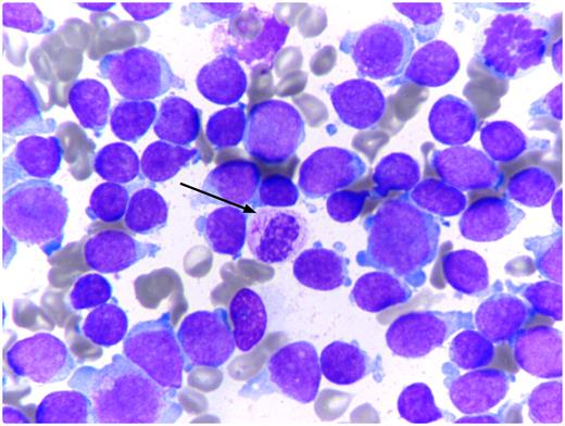 A 17-year-old previously healthy male presented with an incidental finding of pancytopenia and circulating blast cells in the peripheral blood. Bone marrow aspirate and biopsy showed a large population of blast cells. Blast cells showed variability in size, variable amount of cytoplasm, and vacuoles in the cytoplasm. Some contained azurophilic granules. The nuclei were irregular with folding and variably prominent nucleoli. A small population of dysplastic-appearing mature granulocytes contained single or multiple cytoplasmic Auer rods (see figure). Blasts did not contain Auer rods. / Flow cytometry showed mixed lineage leukemia. Approximately 90% of blast cells expressed TdT and CD34 with T-cell markers CD2 and CD7 and cytoplasmic and surface CD3. CD4 and CD8 expression was absent. In addition, these blasts expressed the myeloid markers CD13, CD15, and CD117. There was partial dim expression of cytoplasmic CD22. A small population of blast cells (5%) coexpressed cytoplasmic CD3 and myeloperoxidase. Cytogenetics were normal. / These findings are most consistent with 2008 World Health Organization acute leukemia of ambiguous lineage, subtype mixed phenotype acute leukemia T/myeloid, Not Otherwise Specified. The patient was treated on a high-risk ALL protocol with suboptimal response followed by allogeneic stem cell transplantation. Auer rods in mature neutrophils are extremely rare but described in acute promyelocytic leukemia, acute myeloid leukemia t(8;21), and acute myeloid leukemia with maturation.