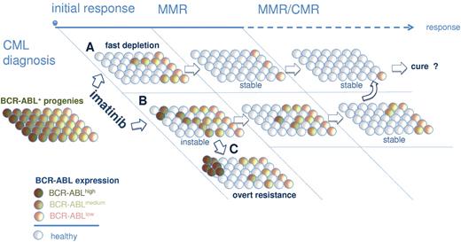 Figure 6. Model for IM-mediated shaping of the BCR-ABL expression repertoire in persisting precursor cells. Immature and mature progenitors express variable levels of BCR-ABL at primary diagnosis of CML (left). BAhigh clones are more sensitive to IM, leading to their preferential depletion from bone marrow compartments in optimal responders (A). A delayed depletion of genetically less stable BAhigh precursors (B) increases the risk for emergence of secondary mutations and IM resistance (C). Depletion of BAhigh and persistence of primarily BAlow progenies would conceivably be required for stable long-term remissions under IM.