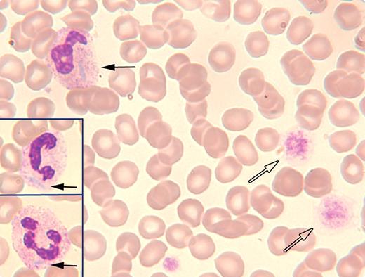 A 35-year-old woman with known May-Hegglin anomaly (and a positive family history) was seen in a fertility clinic. She was found to have marked thrombocytopenia (16 × 109/L). The other cell counts were normal. Other than hypothyroidism that was controlled with levothyroxine, she was otherwise healthy with no evidence of bleeding. The peripheral blood film demonstrated the features of May-Hegglin with megathrombocytes (open arrows) and neutrophils with prominent Döhle-like bodies (neutrophil and inset, solid black arrows). The actual platelet count was underestimated by the automated counter because of the abnormally large platelets. The peripheral smear suggested that the platelet count was higher and a more accurate calculation showed the platelet count to be 56 × 109/L. / May-Hegglin anomaly along with Sebastian syndrome, Fechtner syndrome, and Epstein syndrome are autosomal dominant genetic disorders involving mutations in the MYH9 gene encoding for the nonmuscle myosin heavy chain IIA (NMMHC-IIA). All of these entities are associated with macrothrombocytopenias, leukocyte inclusions (Döhle-like bodies), and variable clinical features of sensorineural hearing loss, cataracts, and renal failure. This case emphasizes the importance of the history and a review of the peripheral smear when abnormally large platelets give false readings on automated cell counters.