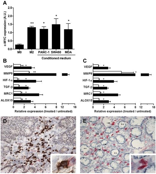 Figure 6. c-Myc is expressed in human TAMs and regulates their phenotype. (A) c-Myc expression in human macrophages cultured or not in the presence of 20 ng/mL of IL-4 (M2 and M0, respectively) or culture medium conditioned by the human tumoral cell lines PANC-1 (pancreas tumor), SW480 (colon tumor), and MDAMB231 (breast tumor). Results are shown as means ± SD of n = 6 independent experiments. (B-C) Expression levels of ALOX15, MRC1, HIF1α, MMP9, TGFβ, and VEGF by single Q-PCR in human macrophages exposed for 24 hours to PANC-1–conditioned medium (B-C closed bars), in the presence of the c-MYC inhibitor 10058-F4 (60μM) (B open bars) or after suppression of c-MYC expression by macrophage transduction with a c-MYC/shRNA (C open bars). Results are the the -fold induction compared with untreated macrophages and represent the means ± SD of n = 4 independent experiments. (D-E) Double immunohistochemical analysis for CD68 (alkaline phosphatase staining: red color) and c-MYC (peroxidase staining: brown color) in specimens of colon cancer (D) and normal colon (E). Hematoxylin counterstaining. Magnification is 20×. In panel D, c-MYC expression is found in neoplastic cells (nuclear pattern, **) and in CD68+ macrophages of the lamina propria (double immunostaining: red and brown). A few c-MYC−/CD68+ macrophages are found (*). **Neoplastic glands; arrows, c-MYC+/CD68+ macrophages; *c-MYC−/CD68+ macrophages. In panel E, CD68+ macrophages, localized in the lamina propria of normal colon mucosa show no c-MYC immunostaining. **Normal colon glands; arrows, CD68+ macrophages. In both panels, inserts show high-magnification fields (100×) of c-MYC/CD68 immunostaining.