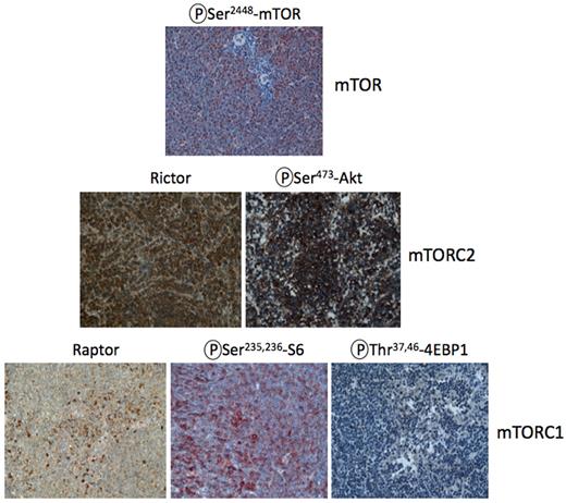 Figure 1. Activation of mTORC1 and mTORC2 signaling in clinical lymphoma samples. MCL samples (n = 10) were stained using antibodies to rictor, raptor, and autophosphorylated mTOR as well as phosphorylation site-specific antibodies for targets downstream of mTORC1 (phospho-Thr37/46-4EBP1, phospho-Ser235/236-ribosomal S6 protein) and mTORC2 (phospho-Ser473-Akt). Similar results were observed in all 10 specimens.