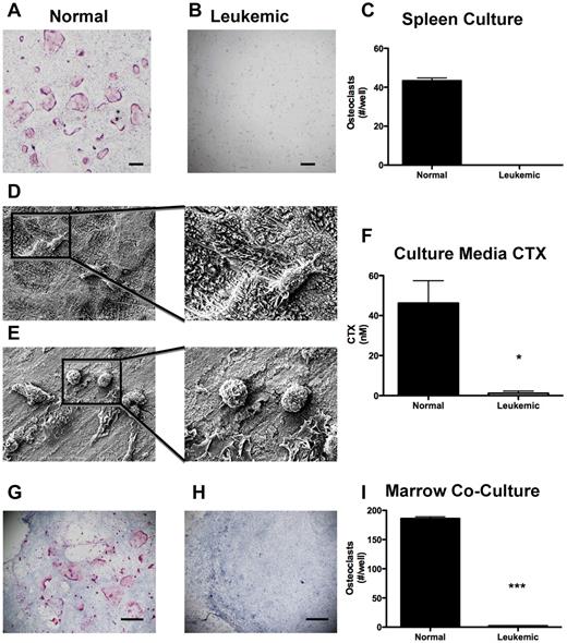 Figure 5. Leukemia cells do not differentiate into osteoclasts and do not resorb bone. Representative light micrographs of (A) normal and (B) leukemic spleen cells under osteoclastogenic conditions in vitro. Pink cells are positive for TRAP activity. (C) Quantification of TRAP+ cells in panels A and B. (D) Low and high power scanning electron micrographs of osteoclasts on bovine bone wafers. (E) Low and high power scanning electron micrographs of leukemia cells on bovine bone wafers. (F) ELISA quantification of CTX released into culture media during culture of cells with bovine bone wafers. (G-H) Representative light micrographs of cocultures containing osteoblasts and (G) normal marrow cells and (H) leukemic marrow cells. (I) Quantification of TRAP+ cells formed per well from osteoblastic cocultures with normal and leukemic marrows. *P ≤ .05. ***P ≤ .001. n = 3 or 4 mice per treatment group.