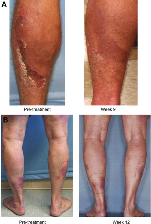 Figure 4. Systemic antitumor clinical response observed with single or dual immunization schedule. (A) Patient 2 (64-year-old man, stage IIB) was treated with the single immunization procedure. Systemic evaluation site was the left calf, and the immunization site was the left thigh. PR was noted at week 8, with DOR of 12 weeks. Patient met progression criteria per mSWAT score at week 20 and withdrew from the trial to start topical steroid therapy. (B) Patient 9 (71-year-old man, stage IB) received dual immunization treatment. Systemic evaluation sites were the lower legs, and lesions on each thigh served as the immunization sites. PR was noted at week 12, with DOR of 6 weeks. Patient withdrew from trial at week 18 to initiate topical nitrogen mustard to small areas of recurrent skin disease.