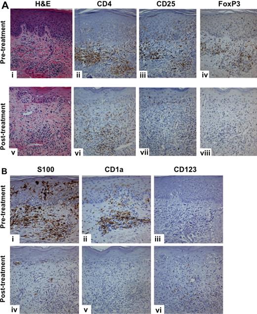 Figure 5. Significant decreases in CD25+, FoxP3+ T cells and APCs, whereas CD123+ pDCs show increases at the immunized site. (A) A significant decrease in the CD25, FoxP3–expressing T-cell infiltrate was noted when comparing skin biopsies taken from the immunization site before and after treatment (week 2). (B) S100+ and CD1a+ DC numbers also decreased at these time points, whereas CD123+ pDC numbers increased. Images were acquired using a model BX51 microscope with a 100×/1.25 NA Plan oil objective lens and Microfire digital camera with PictureFrame Version 2.3 software (Olympus). Digitized images were processed using Photoshop 7 image processing and manipulation software (Adobe Systems).