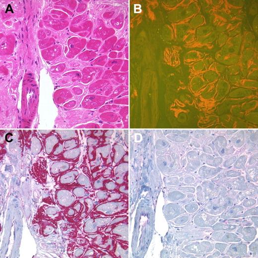 Figure 1. Endomyocardial biopsy of a 69-year-old female patient with a monoclonal gammopathy type IgG lambda. Interstitial amyloid deposits showed a homogeneous eosinophilic staining in the H&E-stained tissue section (A) and yellow-orange fluorescence in Congo red-stained sections (B). The amyloid deposits strongly immunoreacted with an antibody directed against TTR (C). No immunoreactions were found with antibodies directed against λ-light chain (D). A TTR mutation was detected (V30M), making the diagnosis of a hereditary ATTR amyloidosis. Original magnification ×200.