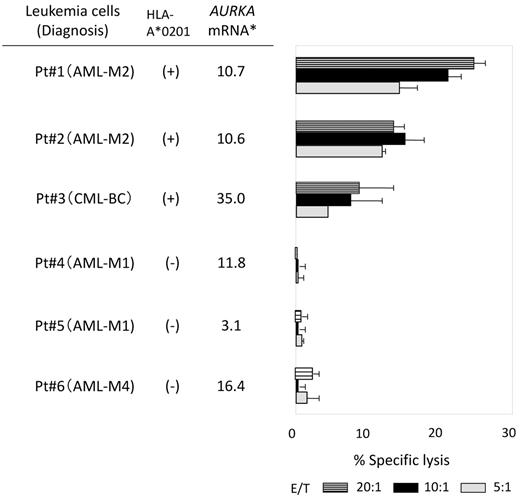 Figure 5. AURKA207-215–specific TCR-transduced CD8+ T cells kill freshly isolated leukemia cells in vitro. Freshly isolated HLA-A*0201+ (n = 3) or HLA-A*0201− (n = 3) acute or chronic myeloid leukemia cells overexpressing AURKA mRNA were used as targets in 51Cr-release assays with AURKA207-215–specific TCR-transduced CD8+ T cells at the indicated effector:target (E/T) ratios. AML, acute myeloid leukemia; BC, blast crisis; CML, chronic myeloid leukemia. M1, M2, and M4 refer to French-American-British classification subtypes (* indicates the expression of AURKA mRNA relative to the mean expression levels across 5 PBMC samples from healthy donors was determined by qRT-PCR and calculated using the comparative ΔCt method). Error bars represent SDs.