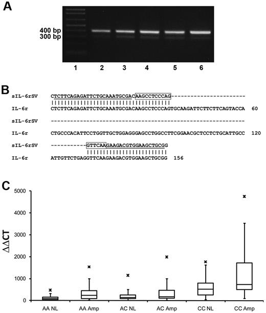 Figure 5. Analysis of DS–IL-6r in MMPC by RT-PCR, sequencing, and qRT-PCR. (A) RT-PCR fragments of the consensus IL-6r (398 bp) and DS–IL-6r (304 bp) in MMPCs from 5 untreated patients. Lane 1, 100-bp DNA ladder (Invitrogen); lane 2, rs2228145 homozygous A patient; lane 3, rs2228145 homozygous C patient; lane 4, rs2228145 heterozygous patient; lane 5, rs2228145 homozygous C patient; and lane 6, rs2228145 homozygous C patient. (B) Alignment of partial sequences from RT-PCR fragments of the DS–IL-6r and the consensus IL-6r transcripts. The deleted 94-bp region can be seen in the alignment. Underlined sequences represent primer targets, and boxed sequences represent reporter target for qRT-PCR of DS–IL-6r. (C) qRT-PCR of DS–IL-6r expression in 106 baseline MM PCs. The rs2228145 allele C and chromosome 1q21 amplification are associated with higher DS–IL-6r expression levels.