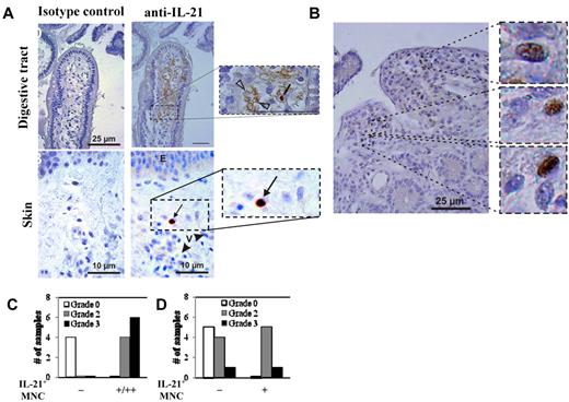 Figure 5. IL-21 protein is expressed in the GI tract and skin, but not the serum, of allo-HSCT patients with GVHD. Samples of colon and skin were biopsied from transplant patients and were stained with anti–IL-21 mAb, counterstained with hematoxylin, and then analyzed in a blinded fashion. (A) Representative examples of gut and skin staining with anti–IL-21 mAb or isotype control antibody. Counts of double immunostained cells were independently assessed by 2 pathologists (P.R. and A.J.) on an Olympus AX 70 microscope with wide-field eyepiece number 26.5 using CellSens software (Olympus). At 400× magnification, this wide-field eyepiece provided a field size of 0.344 mm2. (B) High magnification example of gut staining showing numerous IL-21–expressing MNCs. Graphs comparing the relative amount of anti–IL-21 staining in the gut (C) and skin (D) with the GVHD pathology grade. n = 14 and 16 for GI and skin biopsies, respectively.