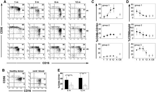 Figure 2. Different size and distribution of donor-derived CD56brightCD16−/low, CD56dimCD16+, and CD56−CD16+ subsets in NK cells reconstituting after intrabone UCBT. (A) Fresh NK cells, collected at the indicated time intervals from recipients of a transplant, were analyzed by double immunofluorescence and FACS analysis for the expression of CD56 and CD16. Three different patients are shown. Dotted lines in the plots separate CD56bright from CD56dim NK-cell subsets. The percentage of each subset is indicated in the different quadrants. (B) For comparison, the distribution and relative percentage of the CD56brightCD16−/low, CD56dimCD16+, and CD56−CD16+ NK-cell subsets are shown for NK cells isolated from representative healthy adult peripheral blood (left) and CB (right). (C-D) The differential development of the CD56negCD16+ (C) and the CD56bright (D) NK-cell subsets are shown as 95% CIs for the mean at 1, 3, 6, and 12 months after UCBT in the 3 groups of patients (Top, group 1 ●; middle, group 2 ■; bottom, group 3 ▴). In each panel the 95% CI for the mean is reported for healthy adult (□) and CB (○) NK-cell subset. (E) The percentage of CD56−CD16+ in group 1 (black histograms) and group 2 (white histograms) patients is shown as 95% CI at 6 and 12 months after UCBT. Statistical significance is indicated (*P < .05).