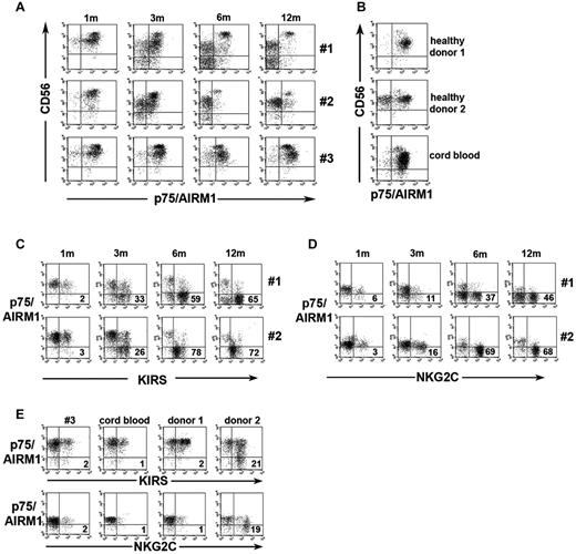 Figure 5. Progressive expansion of p75/AIRM1−KIR+ and p75/AIRM1−NKG2C+ NK cells. (A) Freshly isolated NK cells were double-stained with anti-CD56 and anti-p75/AIRM1 mAbs. Three representative donors from groups 1, 2, and 3 are shown at different time intervals after transplantation. (B) For comparison, NK cells isolated from 2 representative healthy adult donors and 1 CB sample are shown. (C-D) Freshly isolated NK cells were double-stained with anti-p75/AIRM1 and anti-KIR (C) or anti-NKG2C (D) mAbs at 1, 3, 6, and 12 months after UCBT. In the lower right quadrant the percentage of p75/AIRM1−KIR+ and of p75/AIRM1−NKG2C+ cells is indicated. A representative patient from group1 (top) and one from group 2 (bottom) are shown. (E) The same analysis was performed for NK cells from a patient belonging to group 3, a CB, and 2 healthy donors. In the double fluorescence analyses against NKG2C, a different anti-p75/AIRM1 mAb displaying lower reactivity had to be used for technical reasons.