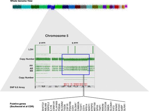Figure 1. Single nucleotide polymorphism 6.0 arrays result in a patient with del 5q in the setting of the 5q− syndrome. There is loss of heterozygosity (LOH) and reduction in copy number in the q arm of chromosome 5. These changes represent a deletion in that region of chromosome 5 (blue box). In an attempt to identify the putative genetic defects that causes 5q− syndrome, several investigators defined different commonly deleted regions (CDRs) in chromosome 5. Shown here are the CDRs from Boultwood et al4 and the putative genes of interest.