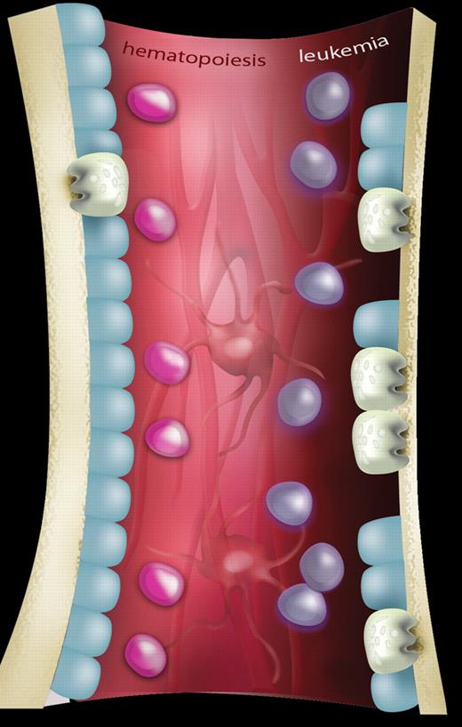 A schematic representation showing the differences in bone homeostasis between normal hematopoiesis and leukemia. In normal hematopoiesis (left side of figure), hematopoietic stem cells (HSCs; pink) are in balance with components of the hematopoietic microenvironment including osteoblastic cells (blue), osteoclasts (gray), mesenchymal cells, and vascular structures (background; red). In leukemia (right side of figure), invasion of leukemia cells (purple) results in osteopenia mediated by an expansion of osteoclasts causing increased bone resorption and a concomitant reduction of osteoblastic activity. The effect, if any, on other components of the HSC niche has yet to be determined. Artwork produced by Ms M. Kersting (QIMR).