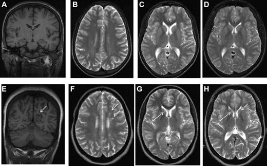 Figure 1. MRI in sickle cell disease. Coronal T1-weighted MRI (A,E) and axial T2-weighted MRI (B-D,F-H) in patients with homozygous SCA. (A-C) Normal MRI in a 19-year-old man with homozygous SCA. (D) Three years later, there is no change. (E-G) Silent infarction (arrows) in the frontal white matter and basal ganglia in a 15-year-old girl with cognitive problems affecting school performance but no acute neurologic presentation. (H) Three years later she has further infarcts with evidence of mild generalized atrophy and had a transient right hemiparesis as well as developing signs of a diplegia.