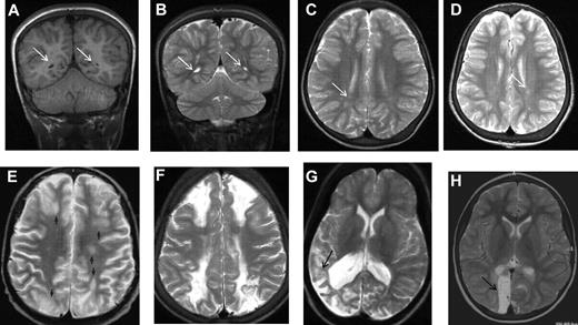 Figure 2. MRI in sickle cell disease. (A) Coronal T1-weighted MRI, (B) coronal T2-weighted MRI, and (C-H) axial T2-weighted MRI in patients with homozygous SCA. (A-C) Silent cerebral infarction (white arrows) in the parietal white matter in a 10-year-old girl with headache. (D) Three years later, there is progressive atrophy on MRI in the context of intermittent ataxia and squint. (E-H) Four cases associated with acute illness. (E) Silent cerebral infarction (black arrows) in the watershed regions between the anterior, middle, and posterior regions, including the deep white matter, in a patient who had previously had posterior reversible encephalopathy syndrome in the context of cyclosporine treatment for nephrotic syndrome. (F) Bilateral watershed infarction in a child who had seizures in the context of a facial infection. Motor examination was normal but his IQ was reduced by 30 points compared with premorbid testing. (G) Encephalomalacia after sagittal sinus thrombosis secondary to pneumococcal meningitis. (H) Occipital infarction after acute chest crisis. A homonymous visual field defect was detected after the infarct was noted on MRI.