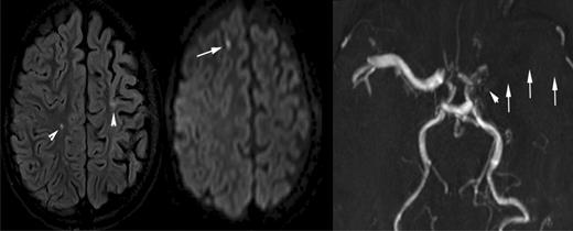 Figure 3. A 10-year-old boy with sickle cell disease and history of acute chest syndrome now presents with pain crisis. MRI of the brain was requested for episodic slurred speech. Axial FLAIR MR image (left) and DWI (middle) illustrate many of the manifestations of SCD in the brain. The arrowheads on the FLAIR image point out areas of old (silent) infarctions in the white matter of the centrum semiovale on the right and at the posterior aspect of the left superior frontal gyrus. The DWI shows an additional area of signal abnormality in the anterior aspect of the right superior frontal gyrus, representing a recent infarction. In addition, there is atrophy of the left cerebral hemisphere, which is seen in the setting of sickle cell–associated vasculopathy manifest by nonvisualization of the left middle cerebral artery by MRA (arrows on the right image). The MRA also shows subtle collaterals (moyamoya vessels) in the lenticulostriate distribution on the left (arrowhead).