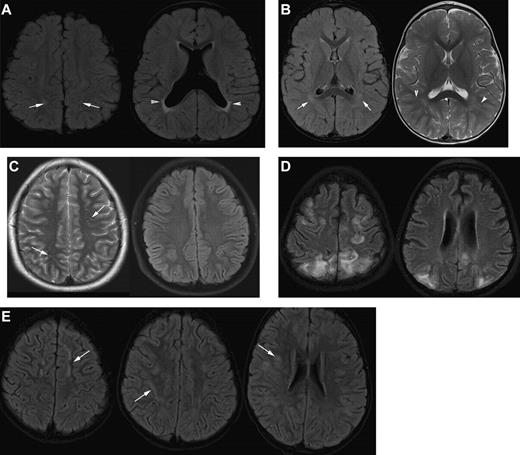 Figure 4. Differential diagnosis of silent infarction (images from patients without SCA). (A) Mimics of SCI: periventricular leukomalacia (PVL). A 20-month-old boy with cerebral palsy characterized by spastic diplegia. Axial FLAIR MR images illustrate classic findings of PVL. The image on the left is at the level of the centrum semiovale and demonstrates bilateral hyperintensities in the parietal lobe white matter. This appearance of the white matter overlaps with the presentation of SCI. The image on the right at the level of the basal ganglia illustrates dysmorphic lateral ventricles, thinning of the periventricular white matter and periventricular signal hyperintensity in a predominantly posterior distribution. Taken together, the images are consistent with the diagnosis of PVL in the setting of prematurity and cerebral palsy rather than SCI. (B) Terminal zones of myelination. A 2-year-old boy with a normal MRI of the brain. The Axial FLAIR MR image (left) shows ill-defined hyperintensity bilaterally in the deep white matter adjacent to the atria of the lateral ventricles (arrows). The T2-weighted image on the right illustrates that there are well-defined linear perivascular spaces (arrowheads) traversing the area of vague hyperintensity. This combination of findings is classic for the terminal zones of myelination, the last areas of the deep white matter to myelinate and displace free water. The terminal zones of myelination remain prominent through the second year of life and become progressively less conspicuous over time. They may be visible into the middle of the first decade of life. (C) Virchow-Robin spaces. A 12-year-old boy withT2-weighted (left) and Axial FLAIR (right) MR images with a normal MRI. The T2-weighted images reveal multiple punctuate white matter hyperintensities that suppresses on FLAIR indicating that the hyperintensities are indistinguishable from cerebrospinal fluid. The fluid attenuation feature of the FLAIR image helps to differentiate perivascular (Virchow-Robin) spaces from SCI. The arrows illustrate another feature of perivascular spaces which is that they appear linear when running within the slice. (D) Posterior reversible encephalopathy syndrome (PRES). A 14-year-old girl with altered mental status and seizures. Axial FLAIR MR images demonstrate hyperintensities bilaterally in the subcortical white matter and overlying cortex with predominant subcortical involvement. The distribution of the signal abnormalities is predominantly posterior and peripheral, a typical distribution for PRES. In contradistinction, SCIs favor the deep white matter of the frontal lobes. Nevertheless, clinical context is the key to differentiating PRES from SCIs. This is especially challenging in patients with SCD because they are prone to development of PRES and SCI. (E) Acute disseminated encephalomyelitis (ADEM). A 5-year-old boy with fever and headache. Axial FLAIR MR images demonstrate patchy, bilateral hyperintensities in the white matter of the centrum semiovale and corona radiata (arrows). Although the image on the left could be confused for SCI in the frontal border zone distribution, the middle and right image show subcortical and patchy hyperintensities that would be atypical in location, size, and lesion definition for SCI. The clinical information is the key to distinguishing lesions of ADEM from SCI.