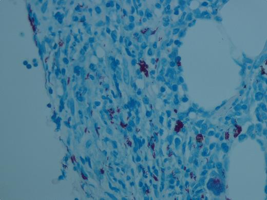 A 48-year-old woman presented with severe epistaxis. Her hematologic profile showed marked thrombocytopenia (3 × 109/L), hemoglobin 11.6 g/dL, leukocyte count 5.2 × 109/L, and an unremarkable blood film except for rare platelets. She tested positive for HIV and the CD4 count was low (20/mm3). / A tentative diagnosis of HIV–immune thrombocytopenic purpura (ITP) was made. She was treated with antiretroviral medications, IVIG, and subsequently with steroids for 4 weeks without improvement. Rituximab was deemed unsafe because of her immunosuppressed status. After 6 weeks of platelet unresponsiveness, a bone marrow examination was performed. The aspirate was dry. The core biopsy showed a hypercellular marrow with a heavy infiltrate of Mycobacterium avium intracellulare infection (ZN stain in figure). She was started on 4-drug antituberculosis treatment, and 2 weeks later her platelet count was 30 × 109/L. The platelet count steadily rose to 150 × 109/L by day 20 and was maintained thereafter. / This case highlights the value of performing a bone marrow examination in a patient with presumed HIV-ITP who was poorly responsive to antiretroviral medications and conventional treatment for immune thrombocytopenia. A secondary opportunistic infection was found by the bone marrow examination and the thrombocytopenia became responsive to therapy for atypical mycobacteria.