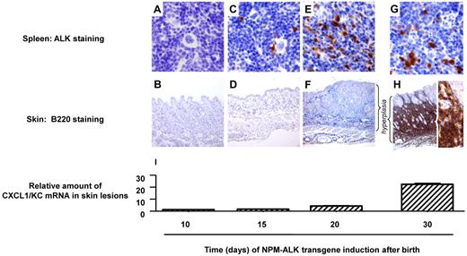 Figure 5. Concomitant increase of serum CXCL1/KC and skin hyperplasia are a prerequisite to NPM-ALK+ lymphoma cell epidermotropism. (A-H) Histological analysis of lymphoma cell dissemination in a conditional mouse transgenic model. Conditional NPM-ALK lymphoma mouse models develop ALK+ B-cell (B220+) lymphomas. Images show normal architecture and negative lymphoma cell staining of spleen (A) and skin 10 (B) and 15 days (D) after birth. Lymphoma cells positive for ALK staining are observed in the spleen 15 (C), 20 (E), and 30 (G) days after birth. Note that the skin presents a hyperplasia of the epidermis and is negative for lymphoma cells staining (B220−; F). In contrast, 30 days after birth, 30% of the animals display B220+ tumoral cells infiltrated below the skin lesions (H; right inset shows magnification of bracket). Original magnification was 400× for the spleen and 100× for the skin, except in panel H, where the original magnification was 50× and 640×, respectively (right inset).