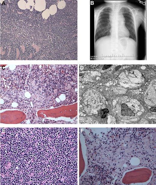 Figure 1. Gross phenotype of T-LBL and GD in the proband and her affected sister. (A) Biopsy of the mediastinal mass showing a T-LBL with diffuse infiltration of the soft tissues by a population of monomorphic lymphoid cells with hyperchromatic nuclei and scant cytoplasm. Immunophenotyping revealed the tumor cells to be positive for CD34 and negative for CD4 and CD8. (B) Chest radiograph of patient 1 demonstrating mediastinal mass at time of initial diagnosis of T-LBL. (C) BM biopsy performed several months later showing the presence of many large macrophages with pale eosinophilic cytoplasm and typical wrinkled tissue paper appearance typical of GD. (D) Electron microscopy performed on the BM shows many Gaucher cells with cytoplasmic striations that represent abundant tubular bodies. (E) Biopsy of the mediastinal mass in patient 2 showing features of T-LBL. (F) BM biopsy from patient 2 showing the presence of many Gaucher cells similar to her sibling.
