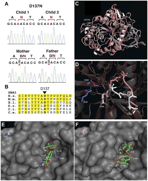 Figure 3. Studies delineating the novel GBA1 D137N mutation. (A) Sanger traces showing heterozygous G > A changes from the parents and homozygous changes from the affected children. (B) Conservation of D137 among orthologs of GBA1. The amino acid segment 129-145 of human GBA1 is shown. Positions identical to human amino acids are highlighted in yellow. H.s. indicates Homo sapiens; M.m., Mus musculus; X.l., Xenopus laevis; D.r., Danio rerio; C.i., Ciona intestinalis; and C.e., C elegans. (C). Overlay of wild-type GBA (2V3E, white) and in silico folded D137N GBA (SWISS-MODEL algorithm, pink) and detailed view of D137N-induced loop change (D). Docking analysis of artificial substrate 4MUGlc on wild-type GBA1 (E) and D137N GBA1 (SWISS-MODEL, F), with distances depicted in Angstroms. Associated energies are depicted in supplemental Figure 3.