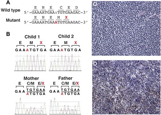 Figure 4. Studies delineating the homozygous insertion mutation in MSH6. (A) Insertion of single base in mutant allele (A, highlighted in red) causes frame-shift and a premature termination codon (X, highlighted in red). (B) Sanger traces showing homozygous insertion of base A from the affected children and heterozygous insertion from the parents. (C) Immunostaining for MSH6 showing loss of normal nuclear staining in the lymphoma cells. (D). Immunostaining for MLH1 showing normal nuclear staining in tumor cells. The results were similar with MSH2 and PMS2 immunostaining (data not shown).