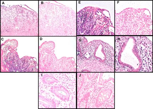 Figure 7. miR-155 expression is up-regulated in the intestinal tract from patients with aGVHD. Histopathologic assessment of human small- and large-bowel samples from patients with aGVHD or from control patients who had a bowel biopsy, but no pathology was observed (controls). In situ hybridization was performed using a digoxigenin-labeled LNA-modified probe complementary to miR-155 or a scrambled LNA control probe. (A) The colon tissue shows marked inflammation with a loss of glands and concomitant erosion. Note that the many inflammatory cells in the lamina propria were positive for miR-155 (dark staining; original magnification ×200). (B) The miR-155 in situ hybridization signal is lost in the same cells in the serial section on using the LNA scramble control probe. (C) A section of ileum shows a normal villous to the left side of the panel, and the loss of the villi in the rest of the section. Note the strong signal in the inflammatory cells in the area of the damaged villi with the miR-155 probe (original magnification ×200). (D) Negative control for panel C, showing loss of the signal with the scrambled probe in the same cells in the serial section. (E-F) The area to the right of the panel C is magnified (original magnification ×400) in panel E (miR-155) and panel F (scrambled probe) to underscore the localization of the signal to mononuclear cells. (G) An earlier stage of GVHD with degenerated/regenerating glands with mononuclear infiltrates, which are primarily located in the lamina propria adjacent to the damaged glands. The miR-155 signal is rare in the damaged epithelial cells but is strong in the adjacent inflammatory cells as shown in higher magnification (×1000) (H) where mononuclear infiltrate into the epithelia, typical of GVHD, is evident. (I-J) Normal colon mucosa negative for miR-155 staining (original magnification ×400).