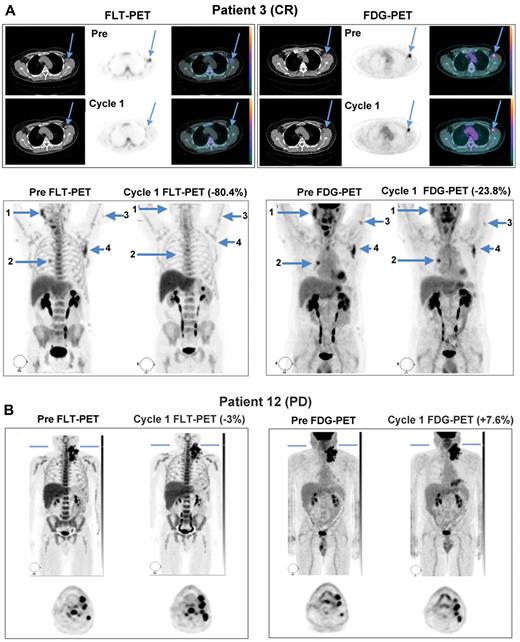 Figure 1. Representative FLT-PET/CT and FDG-PET/CT images at baseline and during the third week of PD0332991 in responding and progressing patients. (A) Images from patient 3, who went on to achieve complete response, demonstrating substantial improvements in FLT uptake and more modest changes in FDG uptake. (B) Images from patient 12, whose best response was disease progression, demonstrating interval increases in the number of lesions and in tracer uptake on both sets of scans.