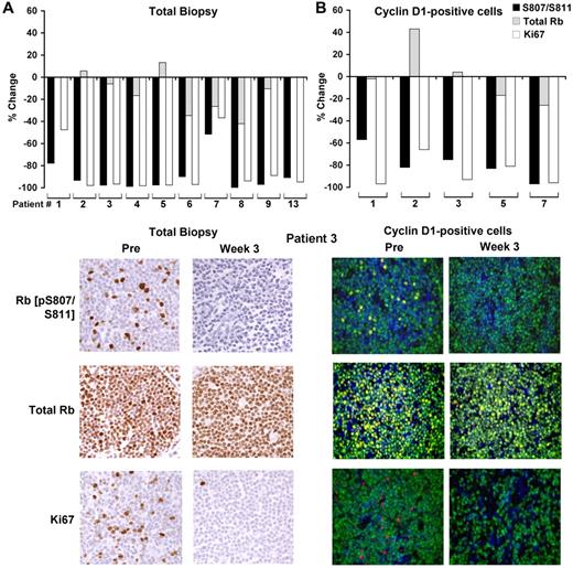 Figure 4. PD0332991-induced changes in Rb phosphorylation and Ki-67 expression in pre- and on-treatment lymph node biopsies. (A) Percent change in expression in phospho-Rb (pS807/S811), total Rb and Ki-67 in the on-treatment biopsy compared with the pre-treatment biopsy (top panels) and representative immunohistochemical images from patient 3, who eventually achieved a complete response (bottom panels). (B) Percent change in expression in phospho-Rb (pS807/S811), total Rb, and Ki-67 in cyclin D1–positive cells in the on-treatment biopsy compared with the pretreatment biopsy and representative immunofluorescence images from patient 3 (bottom panels). Blue indicates DAPI staining; green, cyclin D1; and red/yellow, the indicated Rb or Ki-67 Ab.