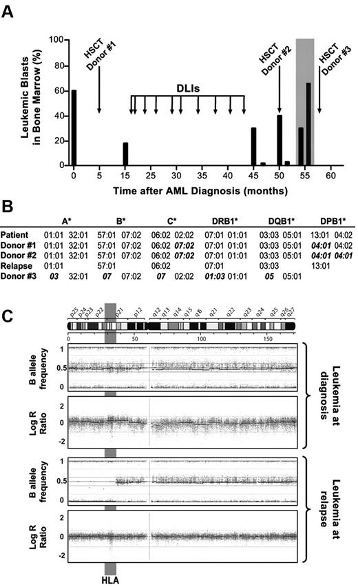Figure 1. Clinical, immunogenetic, and molecular evidence of HLA loss at relapse after MUD HSCT. (A) Clinical course of the patient: histogram bars represent the percentage of leukemic blasts in the bone marrow of the patient at different time points during the posttransplantation follow-up. Boxed in gray is the disease relapse that occurred after the second MUD HSCT, when leukemic blasts were purified by fluorescence-activated cell sorting for further molecular analyses. (B) Genomic HLA typing of the patient before HSCT (and of AML blasts at diagnosis), of the 2 MUDs (donors 1 and 2), of the leukemic blasts purified at relapse after the second MUD HSCT (month 54, boxed in gray in panel A), and of the patient's mother (donor 3). HLA alleles mismatched between donors and patient are shown in bold italics. Homozygosity for HLA-DPB1*04:01 for donor 2 was inferred from univocal genomic typing. (C) Single nucleotide polymorphism (SNP) profile of chromosome 6 from purified AML blasts harvested at diagnosis (top dot plots) and at relapse after the second MUD HSCT (bottom dot plots), analyzed using the Illumina Human660W-Quad BeadChip. Top and bottom plots show the B allele frequency and the LogR ratio, indicating zygosity and gene copy numbers of each SNP, respectively. Note de novo acquired UPD of leukemic blasts at relapse in a 40-Mb region of chromosome 6p encompassing HLA (evidenced in gray).