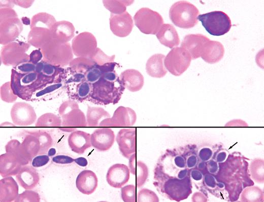 A 16-month-old boy with a history of chronic intestinal dysmotility requiring total parenteral nutrition was admitted with a suspected line-related sepsis. He had a leukocyte count of 4.3 × 109/L, hemoglobin 73 g/L, and platelets 43 × 109/L. Electrolytes, urea, creatinine, coagulation parameters, and liver function tests were all within normal ranges. On the peripheral blood smear, a microcytic anemia with thrombocytopenia was present along with intracellular and extracellular organisms (see figures), some with budding (arrows), in keeping with a fungal sepsis. Fluconazole was started empirically and subsequent blood cultures revealed Candida albicans as the causative agent 2 days later. / Candida species accounts for approximately 9% of hospital-acquired infections in the United States. Consequently, systemic fungal infections have become an important cause of morbidity and mortality, especially in the immunocompromised population. Timely diagnosis of fungemia has proven to be difficult as blood cultures often require 2 to 3 days of incubation. Although sensitivity of the peripheral smear review for yeast infection is low, in this case the peripheral blood smear led to the diagnosis of a blood-borne yeast infection before blood cultures became positive. In suspected patients, careful examination of a peripheral blood smear should be considered.
