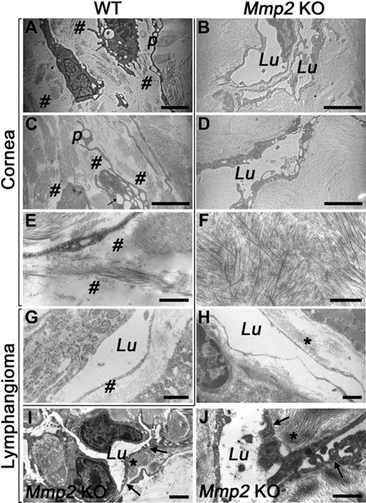 Figure 4. Mmp2 deficiency affects fibrillar collagen remodeling in vivo. TEM of in vivo lymphangiogenesis induced by thermal cauterization of the cornea (A-F) and in lymphangioma (G-J), in WT (A,C,E,G) and Mmp2 KO mice (B,D,F,H-J). (A-C) LECs form long processes (p) and contain intracellular vesicles (arrow). The ECM is extensively remodeled leading to numerous gaps between cells (#). (B-D) In the absence of Mmp2, LECs are surrounded by dense matrix and parallel lumens are often seen (B) in neoformed lymphatic vessels (Lu). (E-F) Higher magnification of the extensively remodeled collagen matrix (#) in WT mice (E), but reminiscent in KO mice (F). (G-H) Neoformed lymphatic vessels in lymphangioma surrounded by processed matrix (#) in WT mice (G), but dense matrix (*) in KO mice (H). (I-J) Lymphatic capillaries forking (arrows) around dense matrix (*) in Mmp2-deficient mice. Bars represent 5 μm (A-D), 1 μm (E,G,H) and 2 μm (F,I,J).