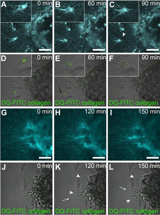 Figure 7. Proteolytic-driven migration of HTERT-HDLECs cells into 3-D collagen gels. Spheroid and collagen fibers are visualized with a reflectance process (A-C,G-I). Dequenched (DQ) FITC collagen (green) becoming fluorescent after cleavage is used to visualize matrix degradation (D-F,J-L). (A-F) Insets show higher magnification of migrating cells. Under control conditions (A-F), a sprouting cell extends protrusion sensing the environment (A-B). Collagen degradation leads to a hole behind moving cell (C; see also supplemental Figure 2). Cleaved collagen appears in the cells (D-F) and at pseudopod–cell body interface (arrow; E). After MMP2 inhibition (G-L), no cell detached from the spheroid (G-I) and cleaved collagen is absent after MMP2 inhibition (J-L). On inhibitor treatment, cells extrude (white arrow) and retract (arrow head) pseudopods (K-L). Bars represent 50 μm in each panel. Live tissues were used in their culture medium and time-lapse imaging was performed using a Fluoview FV1000 confocal microscope (Olympus) at 37°C with Fluoview 3.0a acquisition software (Olympus) and a 60× NA 1.35 UPL SAPO lens (Olympus).
