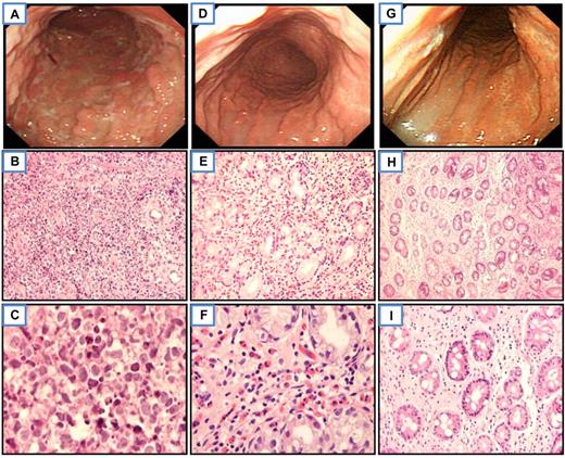 Figure 1. Endoscopic and histologic features of a representative gastric pure (de novo) DLBCL responsive to HPE therapy. Before treatment, multiple irregular-shaped ulcers with residual nodular mucosa at the entire gastric body (A) and diffuse large cells infiltrate in the lamina propria in histology (B-C; H&E, ×400 and ×1000, respectively). Six weeks after HP eradication, complete regression of all diffuse ulcerations with hyperemic and atrophic mucosa at the entire gastric body (D) and biopsy showed prominent eosinophils with scatter small lymphoid cells infiltrate in the lamina propria (E-F). Neither large cells nor features of MALT lymphoma were seen (H&E, ×400 and ×1000, respectively). Six months after HP eradication, nearly normal-appearing mucosa with some wide-based whitish scar at the body of the stomach (G) and biopsy shows scatter small lymphocytes infiltrate only the lamina propria (H-I; H&E, ×100 and ×400, respectively). All slides were observed with light microscopy. An Olympus BX60 microscope equipped with 10×/0.40, 40×/0.95, and 100×/1.35 objective lenses (Olympus) was used to visualize images. Pictures were taken with an Olympus DP70 camera, and Adobe Photoshop 6.0 was used to enlarge the images to their present magnification levels (Adobe Systems).