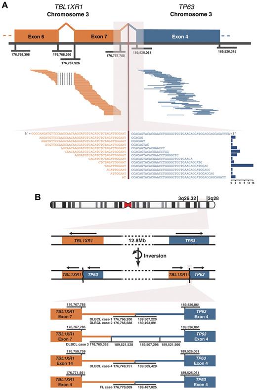 Figure 1. TBL1XR1/TP63 gene fusion observed using paired-end massively parallel RNA sequencing and the genomic fusion breakpoints. (A) Top panel: 77 paired read sequences are shown aligning on either side of the fusion point pairing TBL1XR1 and TP63 in one case of DLBCL. Genomic coordinates of exon boundaries are shown. Bottom panel: 17 split-reads are shown that cross the fusion junction, aligned to the merged sequence of the 2 genes. The histogram on the right of this panel shows the frequency of each split-read, a total of 55 split-reads. (B) An ideogram of chromosome 3 is shown, indicating the locations of TBL1XR1 and TP63 at 3q26.32 and 3q28, respectively. The gene fusions result from chromosomal rearrangement(s) that include an inversion event. Arrows above the genes indicate the direction of transcription. At the bottom, the genomic fusion breakpoints are shown for the 5 cases detected by RNA sequencing. Genomic coordinates are given for the fusion breakpoints and the exon boundaries. In DLBCL case 3, a further inversion event is shown within intron 3 of TP63. All genomic coordinates correspond to the GRCh37 (hg19) human genome assembly.
